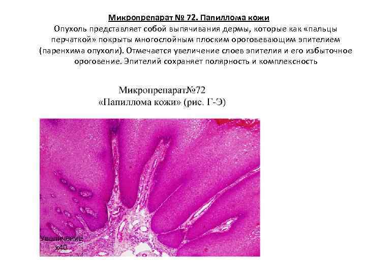     Микропрепарат № 72. Папиллома кожи Опухоль представляет собой выпячивания дермы,