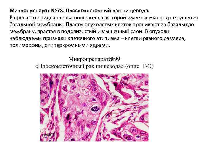Микропрепарат № 78. Плоскоклеточный рак пищевода. В препарате видна стенка пищевода, в которой имеется