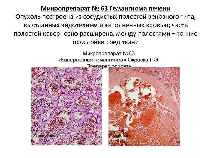   Микропрепарат № 63 Гемангиома печени Опухоль построена из сосудистых полостей венозного типа,