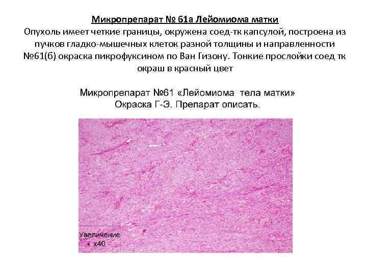    Микропрепарат № 61 а Лейомиома матки Опухоль имеет четкие границы, окружена