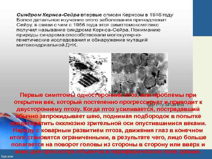   Первые симптомы односторонний птоз, или проблемы при открытии век, который постепенно прогрессирует