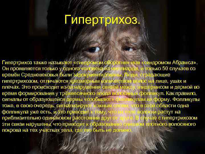     Гипертрихоз также называют «синдромом оборотня» или «синдромом Абрамса» . Он