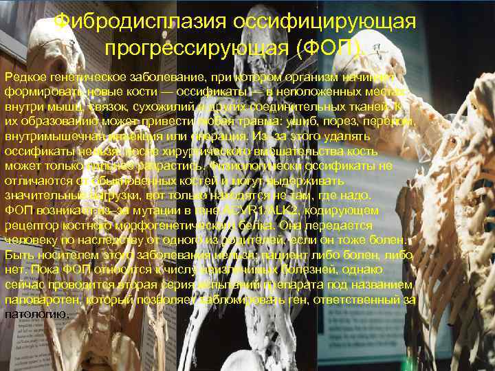   Фибродисплазия оссифицирующая  прогрессирующая (ФОП). Редкое генетическое заболевание, при котором организм начинает