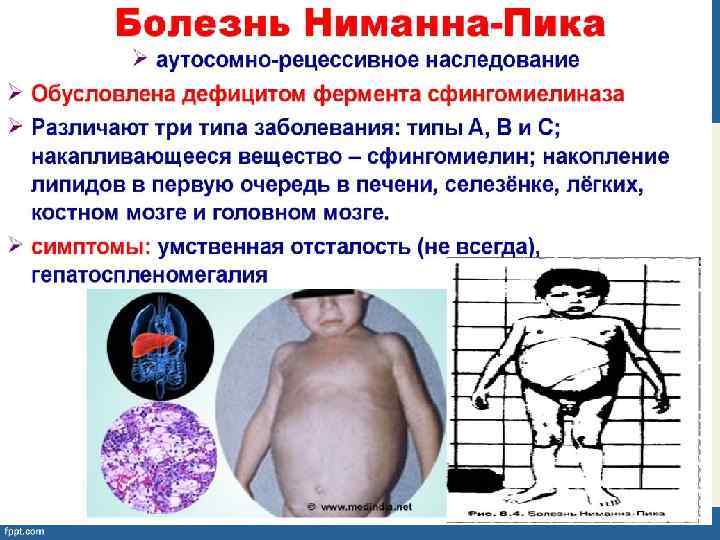 Болезнь Ниманна — Пика 