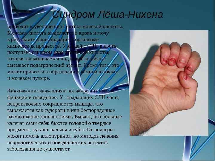 Синдром Лёша — Нихена 