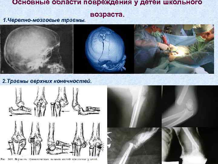   Основные области повреждения у детей школьного     возраста. 1.