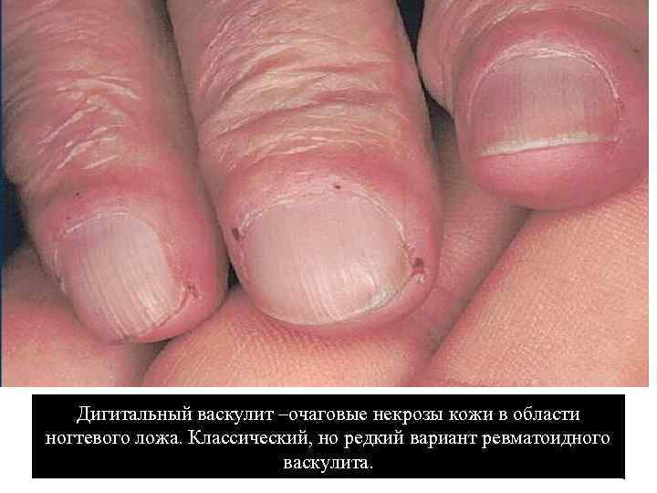   Дигитальный васкулит –очаговые некрозы кожи в области ногтевого ложа. Классический, но редкий
