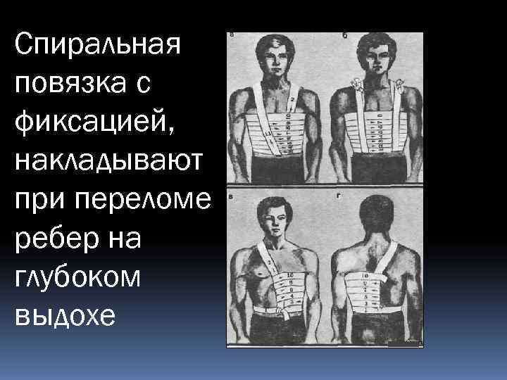 Спиральная повязка с фиксацией, накладывают при переломе ребер на глубоком выдохе 