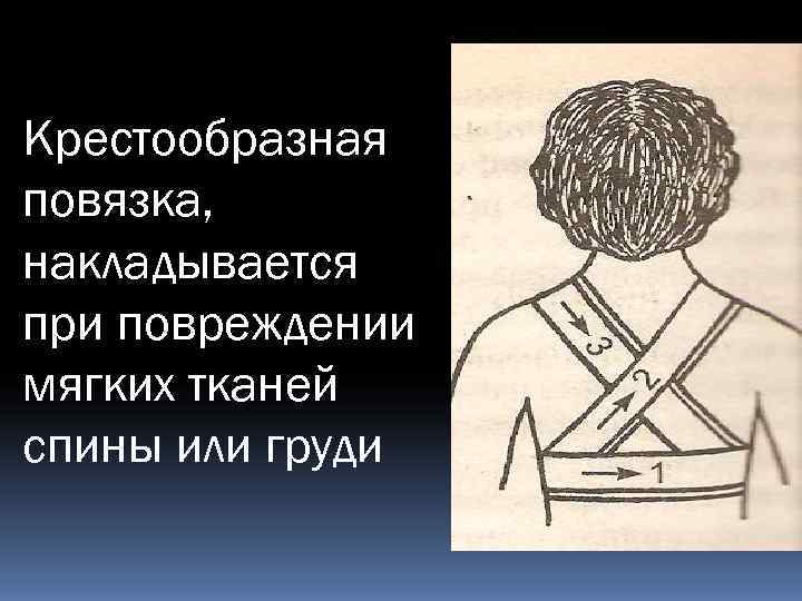 Крестообразная повязка, накладывается при повреждении мягких тканей спины или груди 