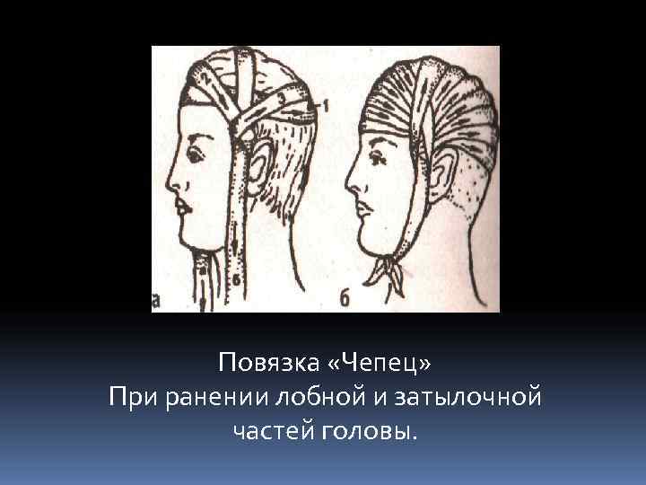   Повязка «Чепец» При ранении лобной и затылочной   частей головы. 