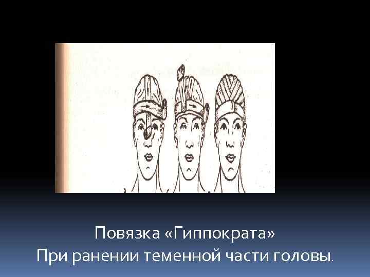     П  Повязка «Гиппократа» При ранении теменной части головы. 