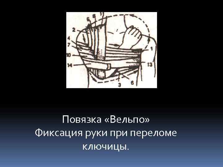   Повязка «Вельпо» Фиксация руки при переломе   ключицы. 