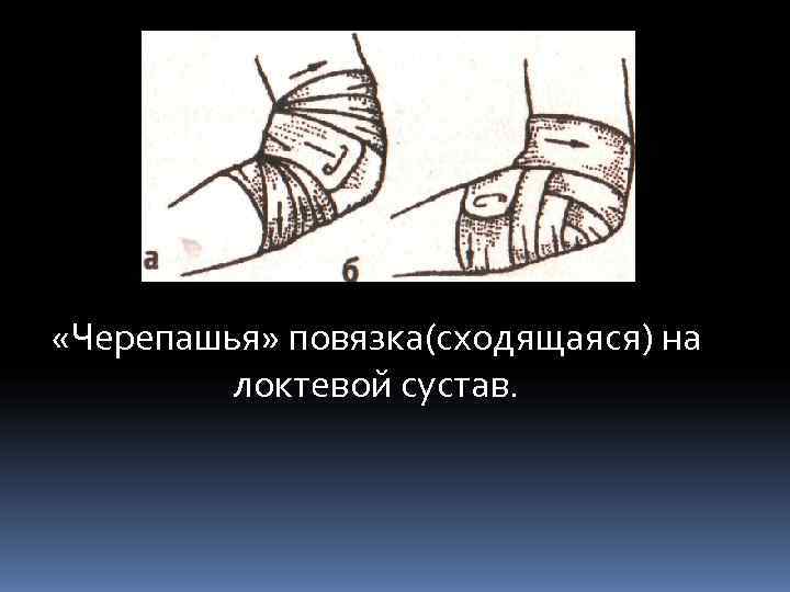 Повязка на локоть. Черепашья сходящаяся повязка алгоритм. Сходящаяся черепашья повязка показания. Черепашья сходящиеся на локте. Черепашья повязка на локоть.