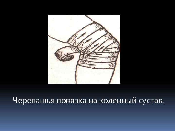 Черепашья повязка на коленный сустав. 