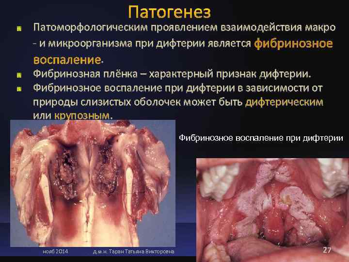 Патоморфологическим проявлением взаимодействия макро - и микроорганизма при дифтерии является   . 