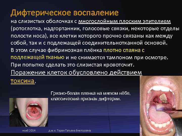 на слизистых оболочках с многослойным плоским эпителием (ротоглотка, надгортанник, голосовые связки, некоторые отделы полости