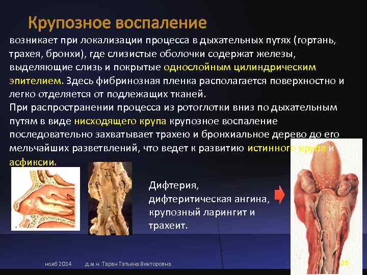 возникает при локализации процесса в дыхательных путях (гортань,  трахея, бронхи), где слизистые оболочки