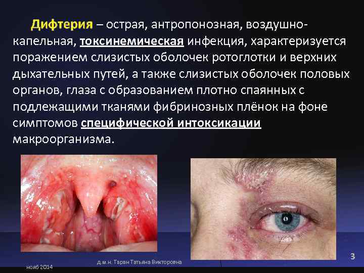  Дифтерия – острая, антропонозная, воздушно- капельная, токсинемическая инфекция, характеризуется поражением слизистых оболочек