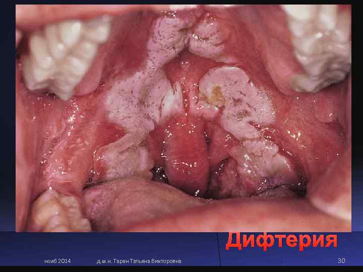      Дифтерия нояб 2014  д. м. н. Таран Татьяна