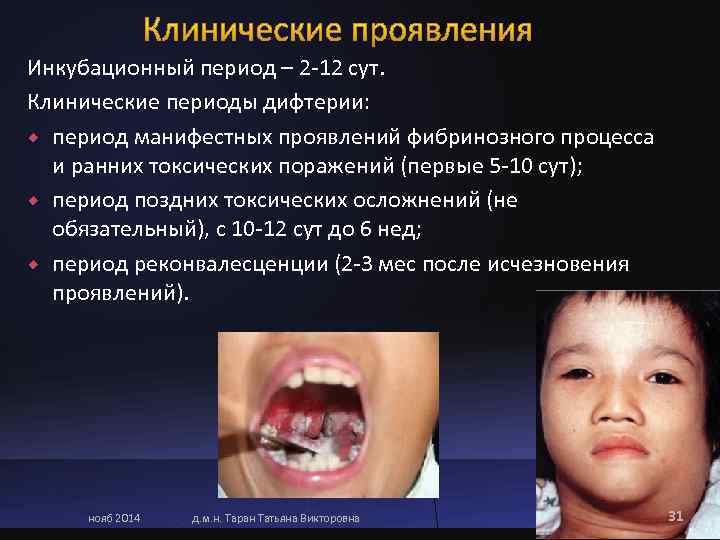Инкубационный период – 2 -12 сут.  Клинические периоды дифтерии:  период манифестных проявлений