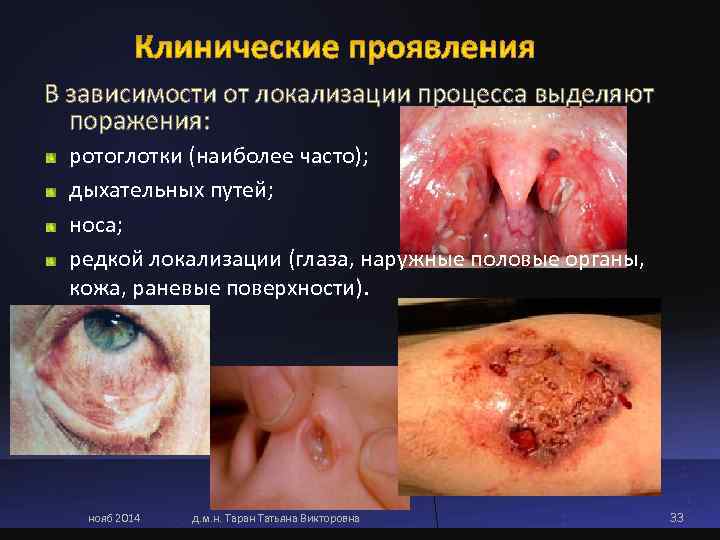 В зависимости от локализации процесса выделяют  поражения:  ротоглотки (наиболее часто);  дыхательных