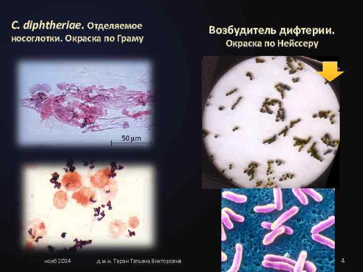 C. diphtheriae. Отделяемое     Возбудитель дифтерии. носоглотки. Окраска по Граму 