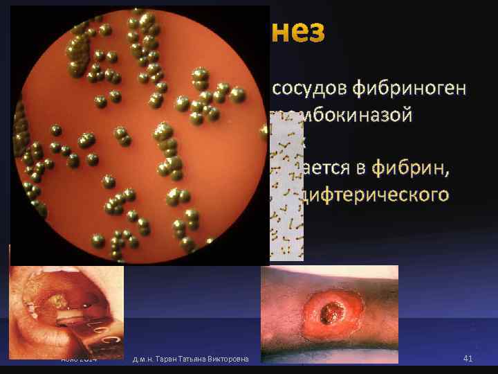   Вышедший за пределы сосудов фибриноген плазмы, контактируя с тромбокиназой некротизированных клеток макроорганизма,