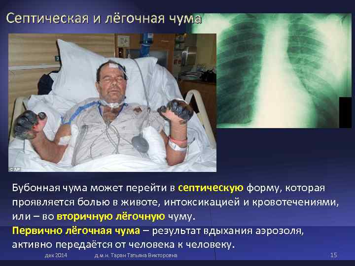 Септическая и лёгочная чума Бубонная чума может перейти в септическую форму, которая проявляется болью Септическая и лёгочная чума Бубонная чума может перейти в септическую форму, которая проявляется болью