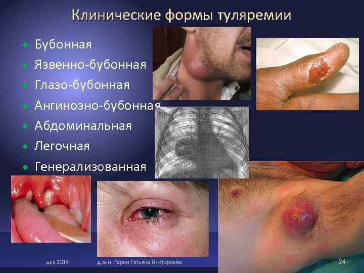 Клинические формы туляремии Бубонная Язвенно-бубонная Глазо-бубонная Ангинозно-бубонная Абдоминальная Легочная Генерализованная Клинические формы туляремии Бубонная Язвенно-бубонная Глазо-бубонная Ангинозно-бубонная Абдоминальная Легочная Генерализованная