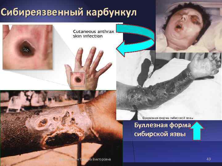 Сибиреязвенный карбункул Буллезная форма сибирской язвы Сибиреязвенный карбункул Буллезная форма сибирской язвы