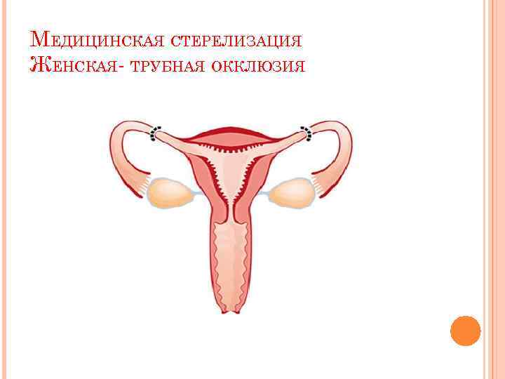 МЕДИЦИНСКАЯ СТЕРЕЛИЗАЦИЯ ЖЕНСКАЯ- ТРУБНАЯ ОККЛЮЗИЯ 