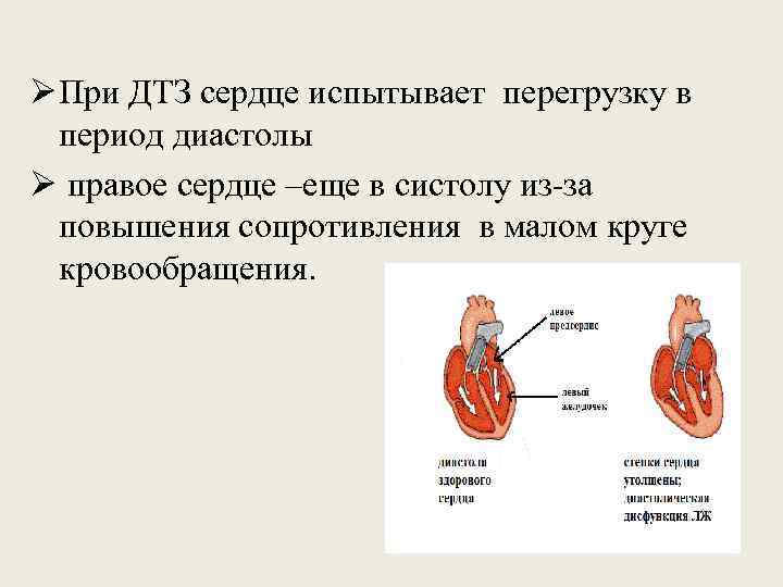 Ø При ДТЗ сердце испытывает перегрузку в  период диастолы Ø правое сердце –еще