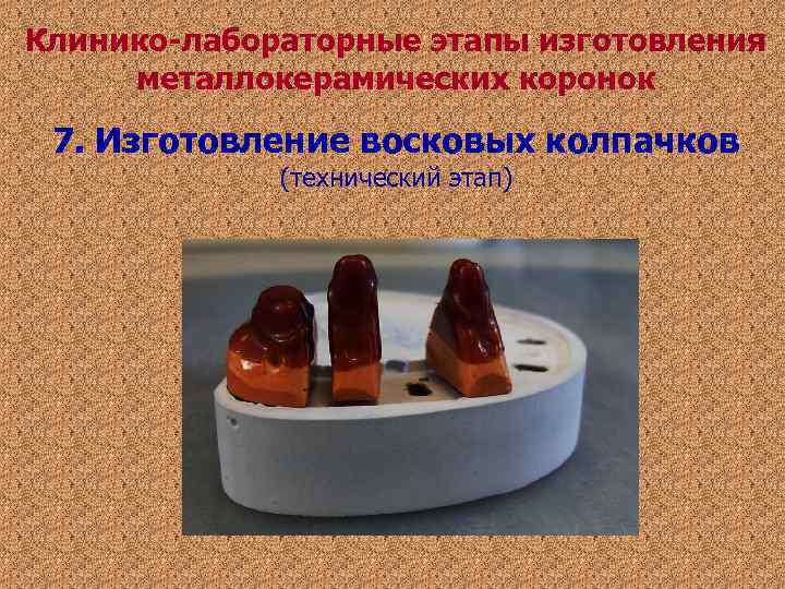 Клинико-лабораторные этапы изготовления металлокерамических коронок 7. Изготовление восковых колпачков (технический этап) Клинико-лабораторные этапы изготовления металлокерамических коронок 7. Изготовление восковых колпачков (технический этап)
