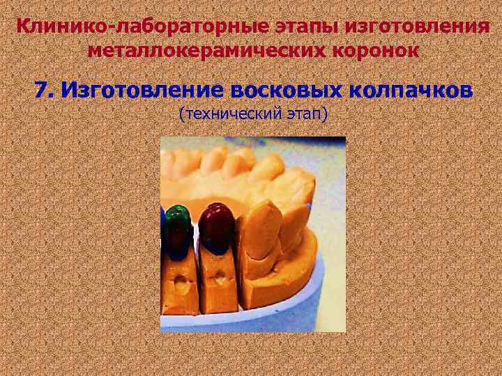 Клинико-лабораторные этапы изготовления металлокерамических коронок 7. Изготовление восковых колпачков (технический этап) Клинико-лабораторные этапы изготовления металлокерамических коронок 7. Изготовление восковых колпачков (технический этап)