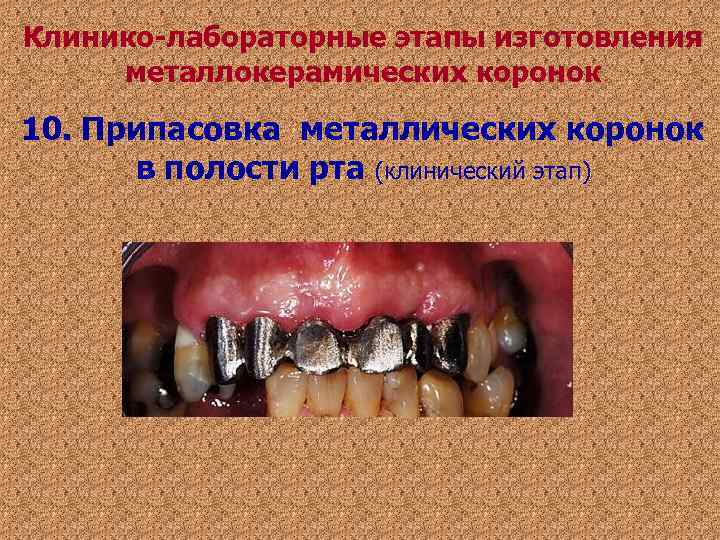 Клинико-лабораторные этапы изготовления металлокерамических коронок 10. Припасовка металлических коронок в полости рта (клинический Клинико-лабораторные этапы изготовления металлокерамических коронок 10. Припасовка металлических коронок в полости рта (клинический
