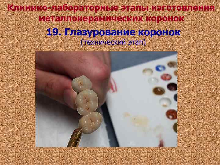 Клинико-лабораторные этапы изготовления металлокерамических коронок 19. Глазурование коронок (технический этап) Клинико-лабораторные этапы изготовления металлокерамических коронок 19. Глазурование коронок (технический этап)