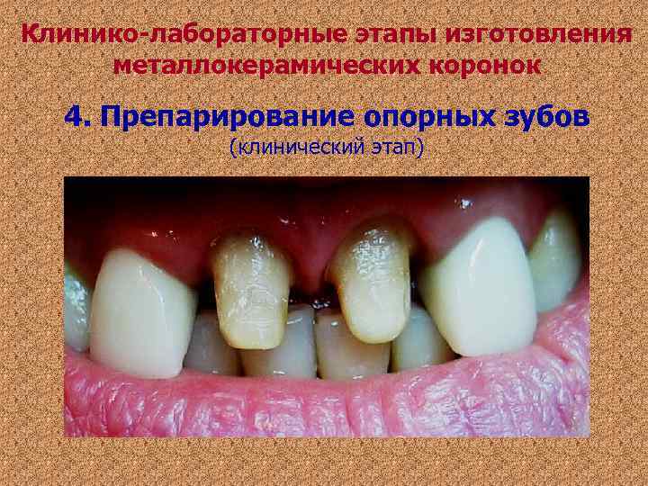 Клинико-лабораторные этапы изготовления металлокерамических коронок 4. Препарирование опорных зубов (клинический этап) Клинико-лабораторные этапы изготовления металлокерамических коронок 4. Препарирование опорных зубов (клинический этап)