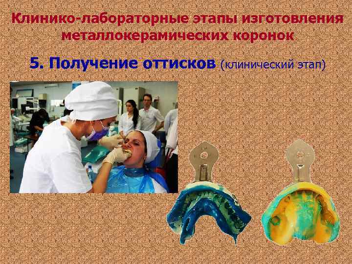 Клинико-лабораторные этапы изготовления металлокерамических коронок 5. Получение оттисков (клинический этап) Клинико-лабораторные этапы изготовления металлокерамических коронок 5. Получение оттисков (клинический этап)