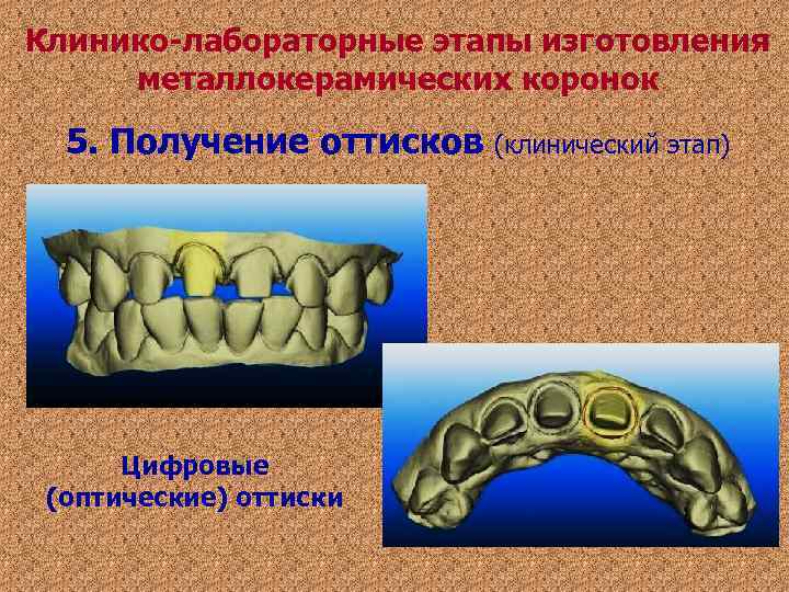 Клинико-лабораторные этапы изготовления металлокерамических коронок 5. Получение оттисков (клинический этап) Цифровые (оптические) Клинико-лабораторные этапы изготовления металлокерамических коронок 5. Получение оттисков (клинический этап) Цифровые (оптические)