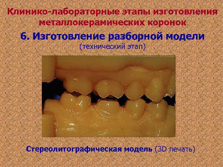 Клинико-лабораторные этапы изготовления металлокерамических коронок 6. Изготовление разборной модели (технический Клинико-лабораторные этапы изготовления металлокерамических коронок 6. Изготовление разборной модели (технический