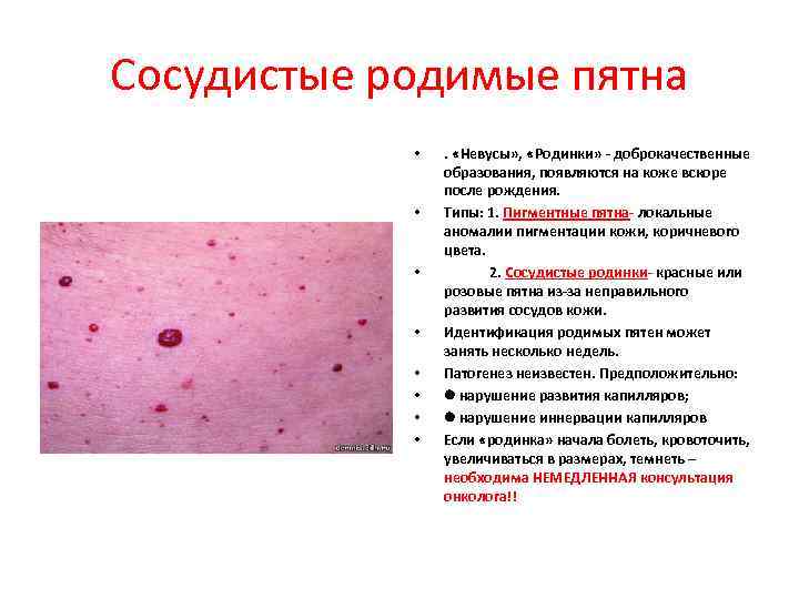 Сосудистые родимые пятна   •  .  «Невусы» ,  «Родинки» -