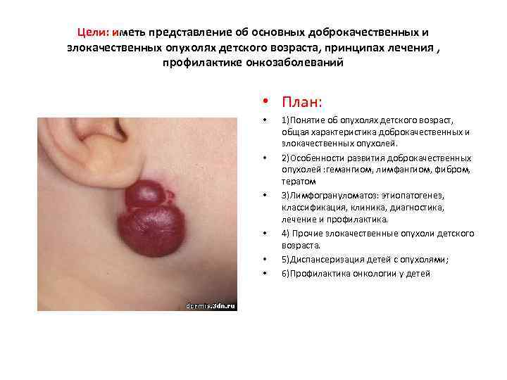  Цели: иметь представление об основных доброкачественных и злокачественных опухолях детского возраста, принципах лечения