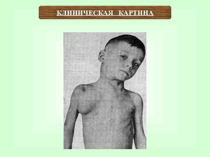 КЛИНИЧЕСКАЯ КАРТИНА 