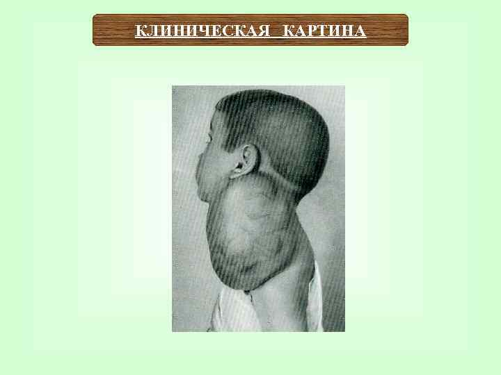 КЛИНИЧЕСКАЯ КАРТИНА 