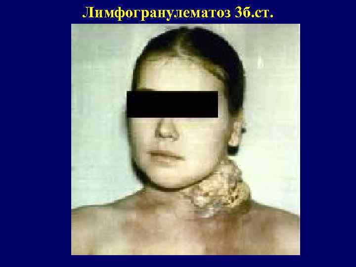 Лимфогранулематоз 3 б. ст. 