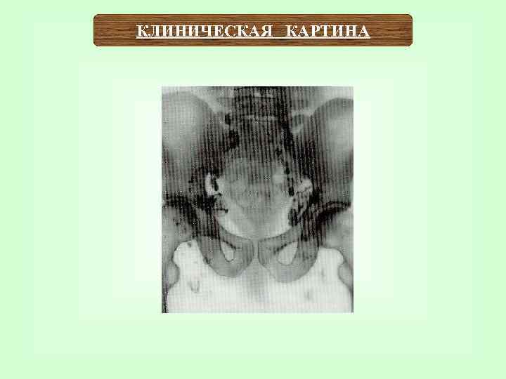 КЛИНИЧЕСКАЯ КАРТИНА 