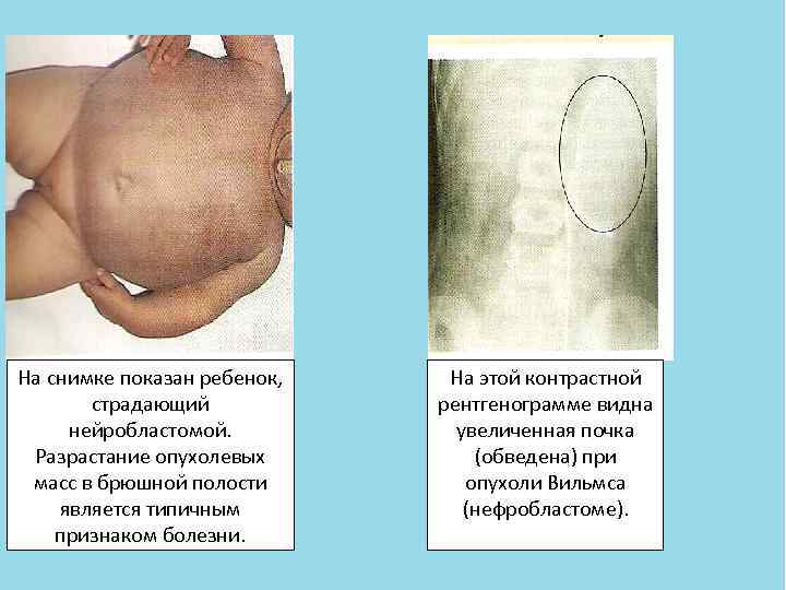 На снимке показан ребенок, На этой контрастной   страдающий   рентгенограмме видна