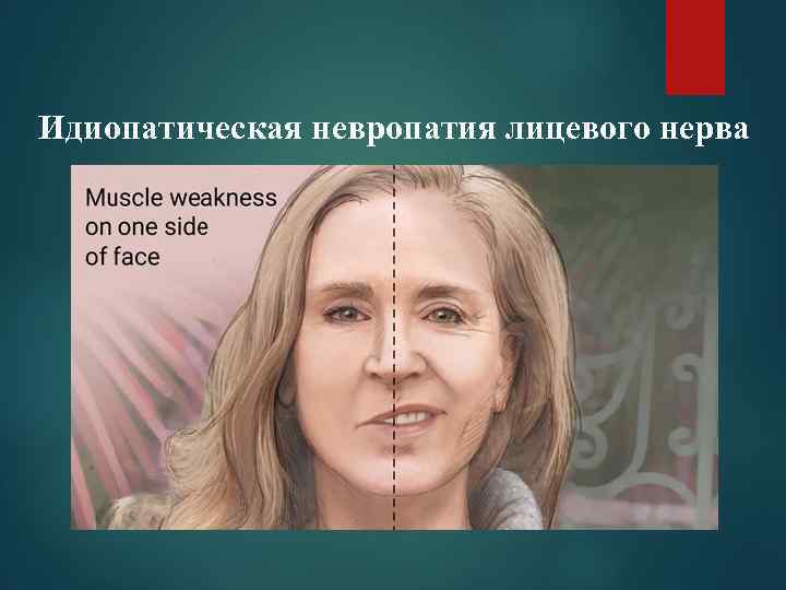 Идиопатическая невропатия лицевого нерва 