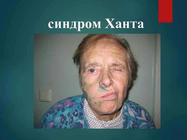 синдром Ханта 