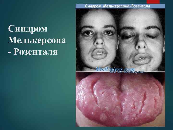 Синдром Мелькерсона - Розенталя 
